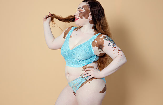 vitiligo queen - #PerfectFigure Ambassador